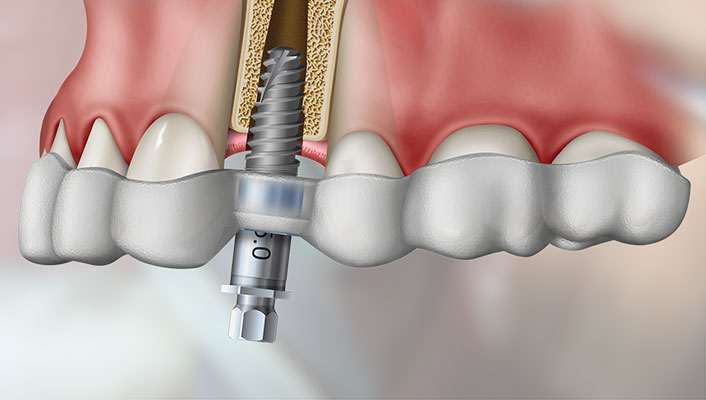 cirurgia-guiada-implante-1